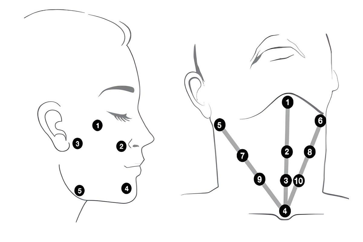 The main injection pois of Profilo in the face