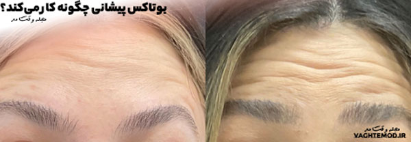 Forehead Botox paralyzes the muscles of the forehead for a limited time.
