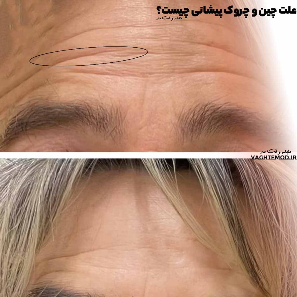 Aging and frowning are the causes of forehead wrinkles.