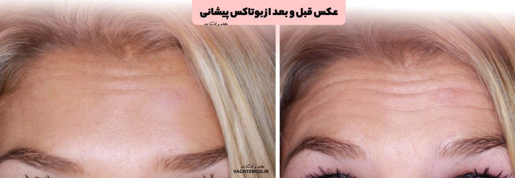 Photo before and after forehead botox
