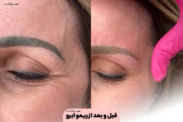 Photo before and after Remo Eyebrow