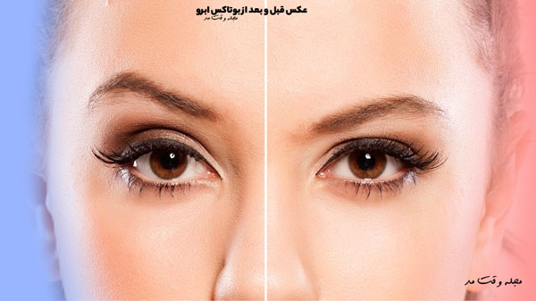 Photo before and after Botox eyebrow