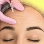 Forehead Botox is used to eliminate forehead wrinkles and wrinkles.