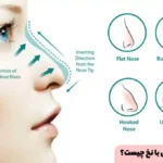 Rhinoplasty is a non-surgical, minimally invasive, reversible treatment with predictable results for people looking for a non-surgical alternative to their nose.