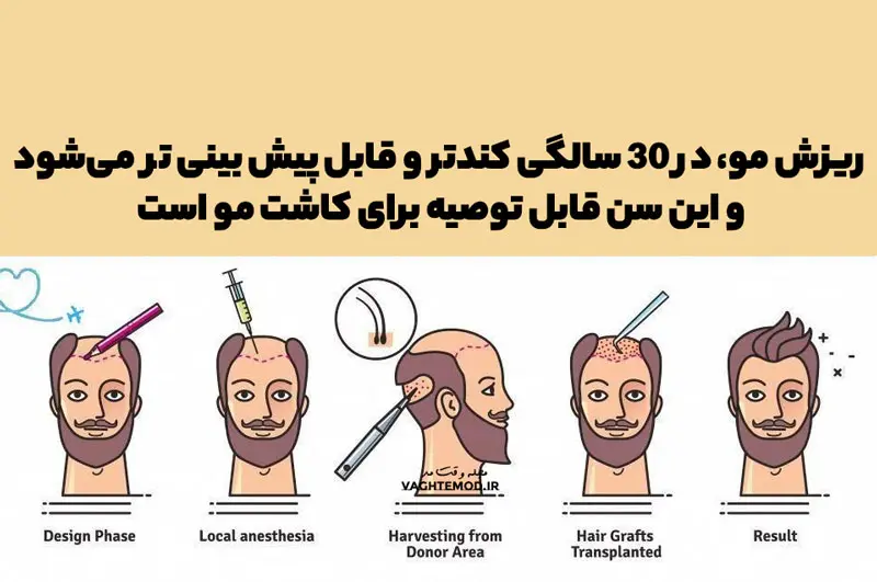 From what age can hair transpla be done?