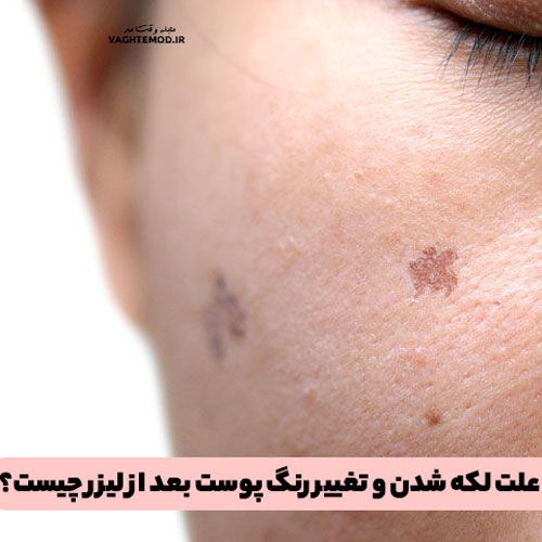 What is the cause of skin discoloration and discoloration after laser?