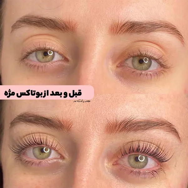 Photo before and after Botox eyelashes