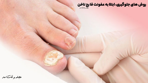 Methods of preveing nail fungal infection