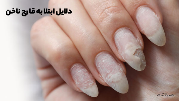 The causes of nail fungus