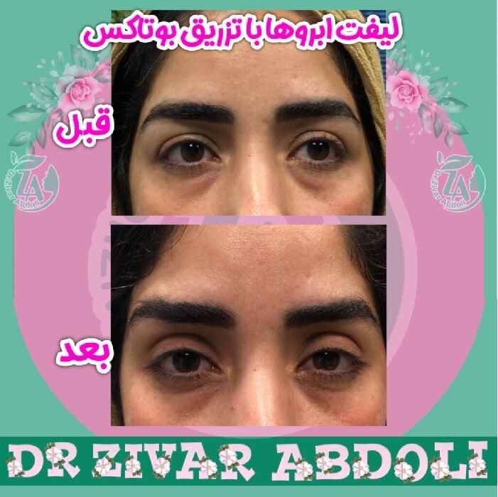 Eyebrow lift with Botox injection