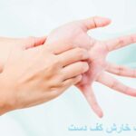The cause of the itching of the palm