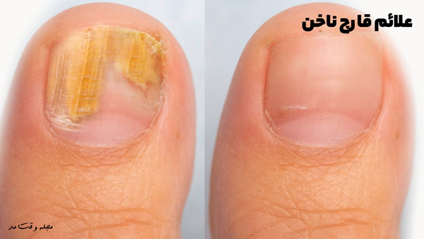 Symptoms of nail fungus