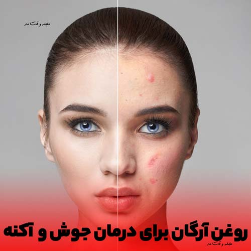 Use argan oil on skin, pimples and acne and change it 