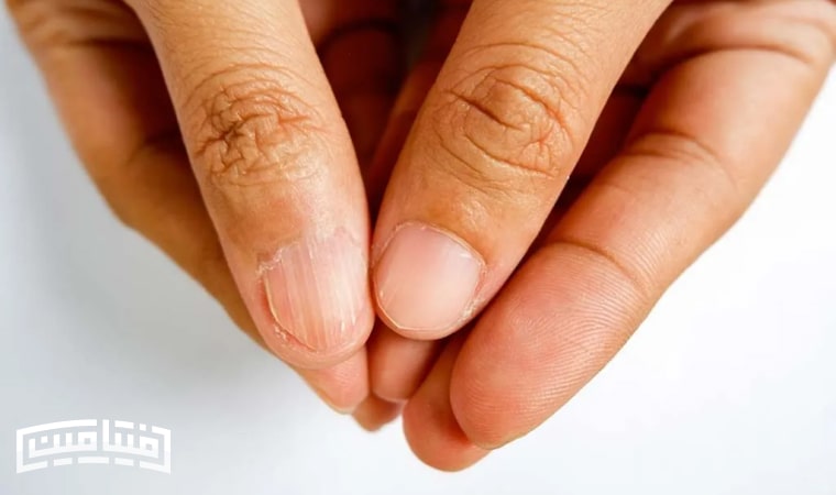 A sign of protein deficiency in the body