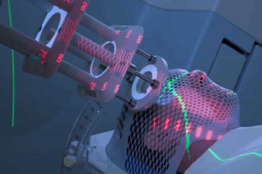Side effects of radiotherapy