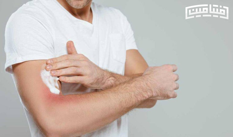 Eczema treatme