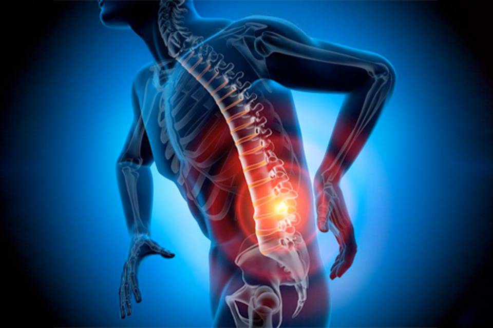 Piroxicam oime for sciatica