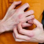 What is eczema
