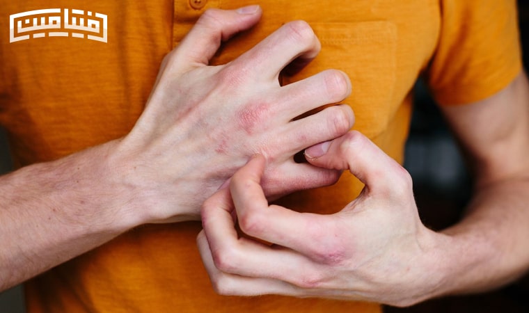 What is eczema