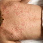 Video/ Increases the Prevalence of Measles in America; ۱ Staters clashed