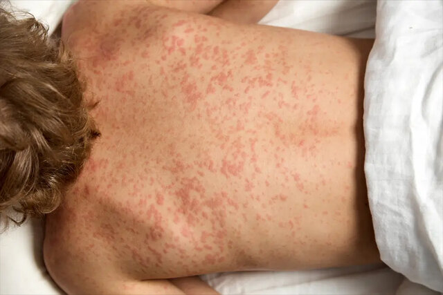 Video/ Increases the Prevalence of Measles in America; ۱ Staters clashed
