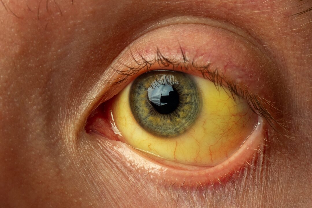 What is a sign of yellowing? Is dangerous? What to eat for treatme of yellowing?