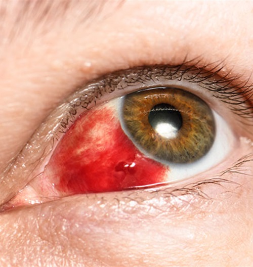 The cause of blood stain in the white eye