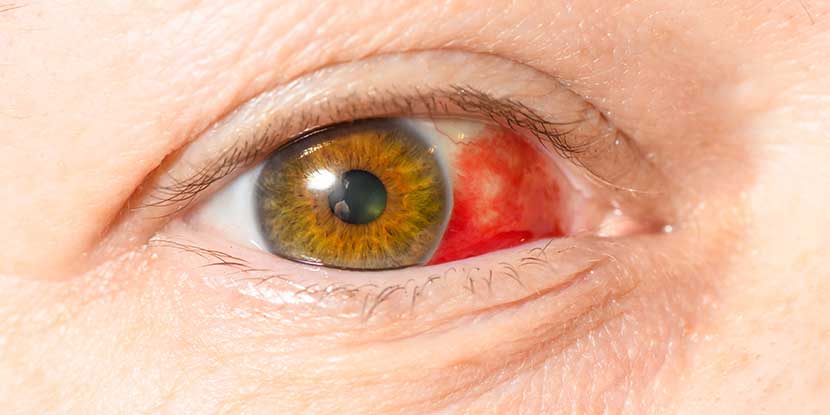 Treatme of blood stain in the eye due to impact