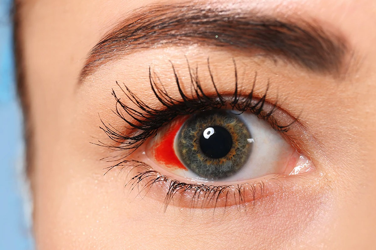 Drop names for blood stain in the eye