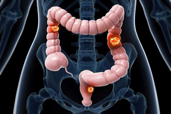 What is the test of colon cancer at home?