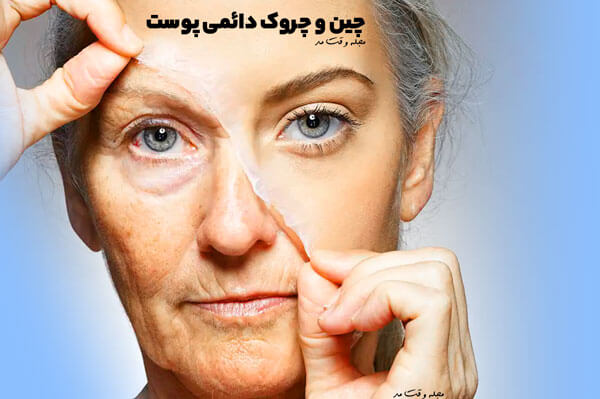 Static or fixed wrinkles are the most common cause of wrinkles