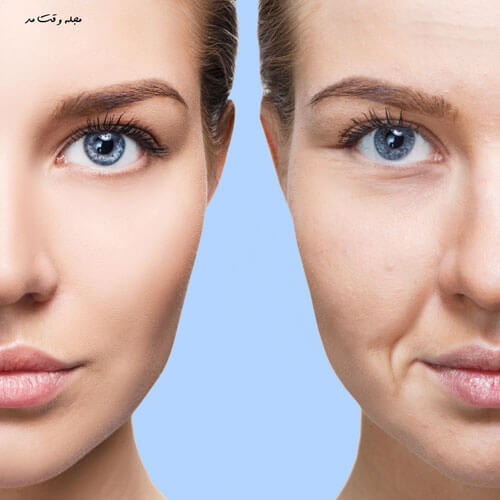 Dynamic or dynamic wrinkles are lines caused by freque facial muscles, muscle coraction, and emotions.