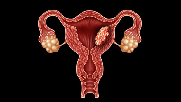 Treatme of uterus enlargeme in traditional medicine