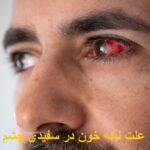 The cause of blood stain in the white eye