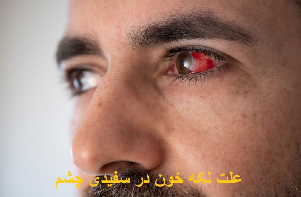 The cause of blood stain in the white eye