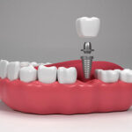 Types of Dental Implant Brands