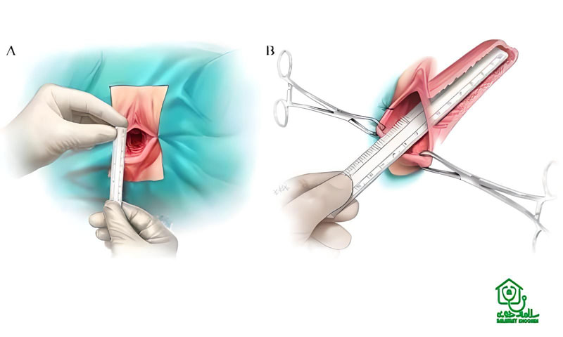 Vaginoplasty