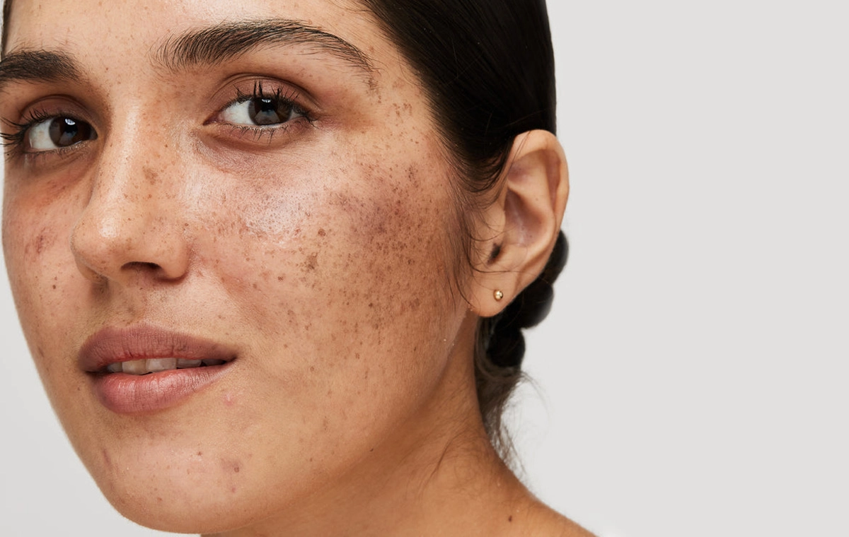 Melasma