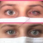 Eye color correction without surgical