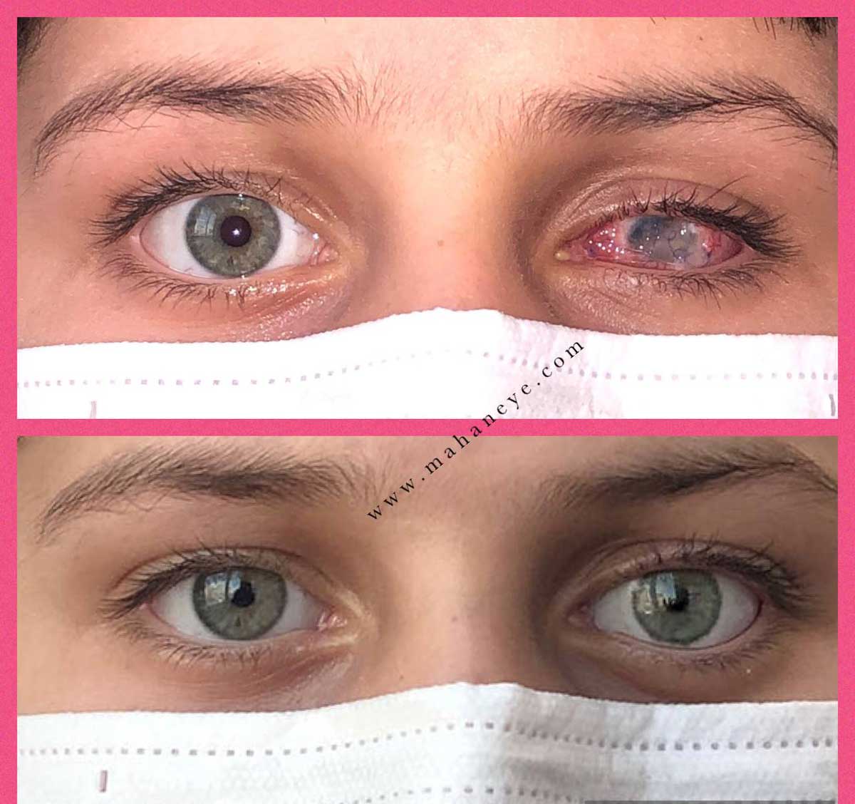 Eye color correction without surgical