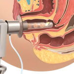 Vaginoplasty