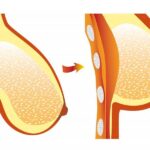 Breast Cosmetic Surgery - Mammoplasty