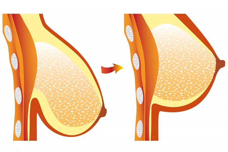 Breast Cosmetic Surgery - Mammoplasty
