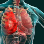 Video/ Stress has four times the risk of exacerbation of lung disease