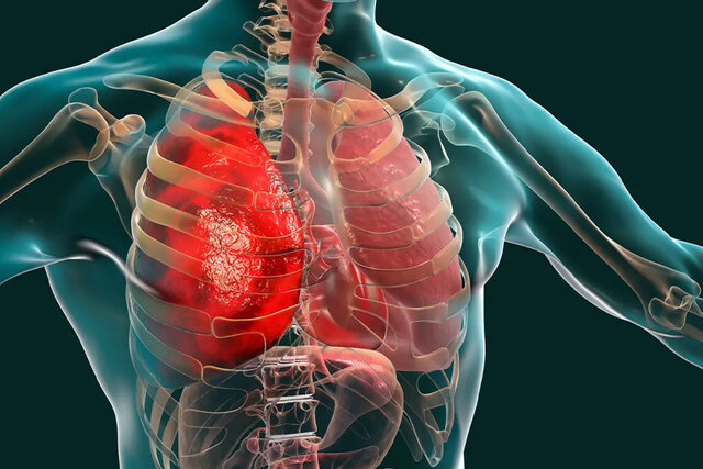Video/ Stress has four times the risk of exacerbation of lung disease