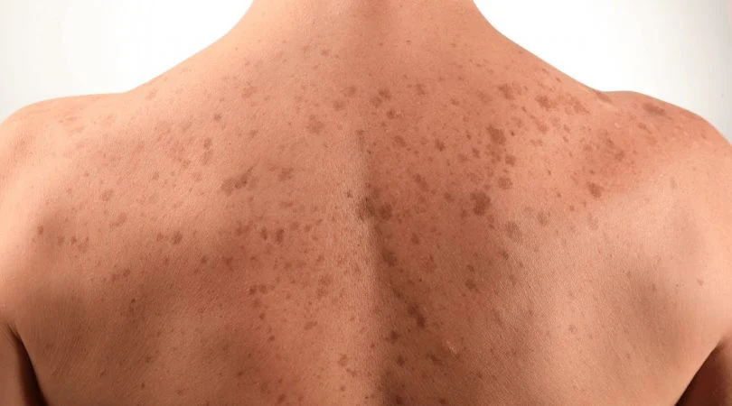 What is the sign of black spots on the face and body of the face?