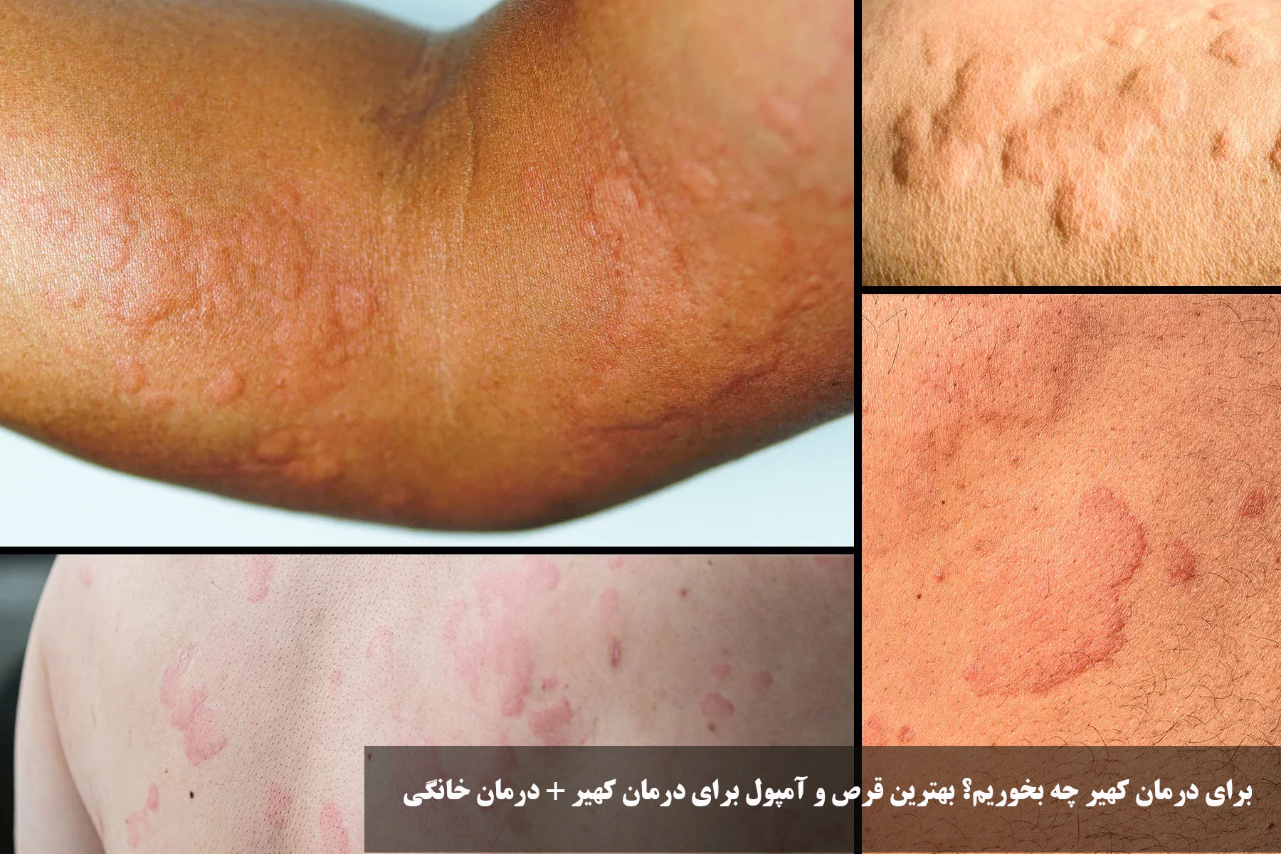 What can we eat for the treatment of urticaria? The best pill and ampoules for the treatment of urticaria + home therapy