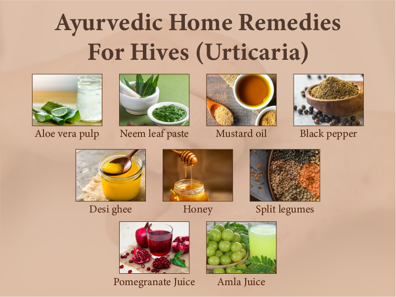 Home treatme of urticaria