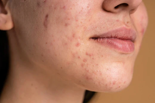 Treatme of black spots on the skin