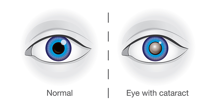 Is the cataract of the eye dangerous